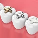 three types of dental fillings