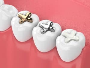 three types of dental fillings